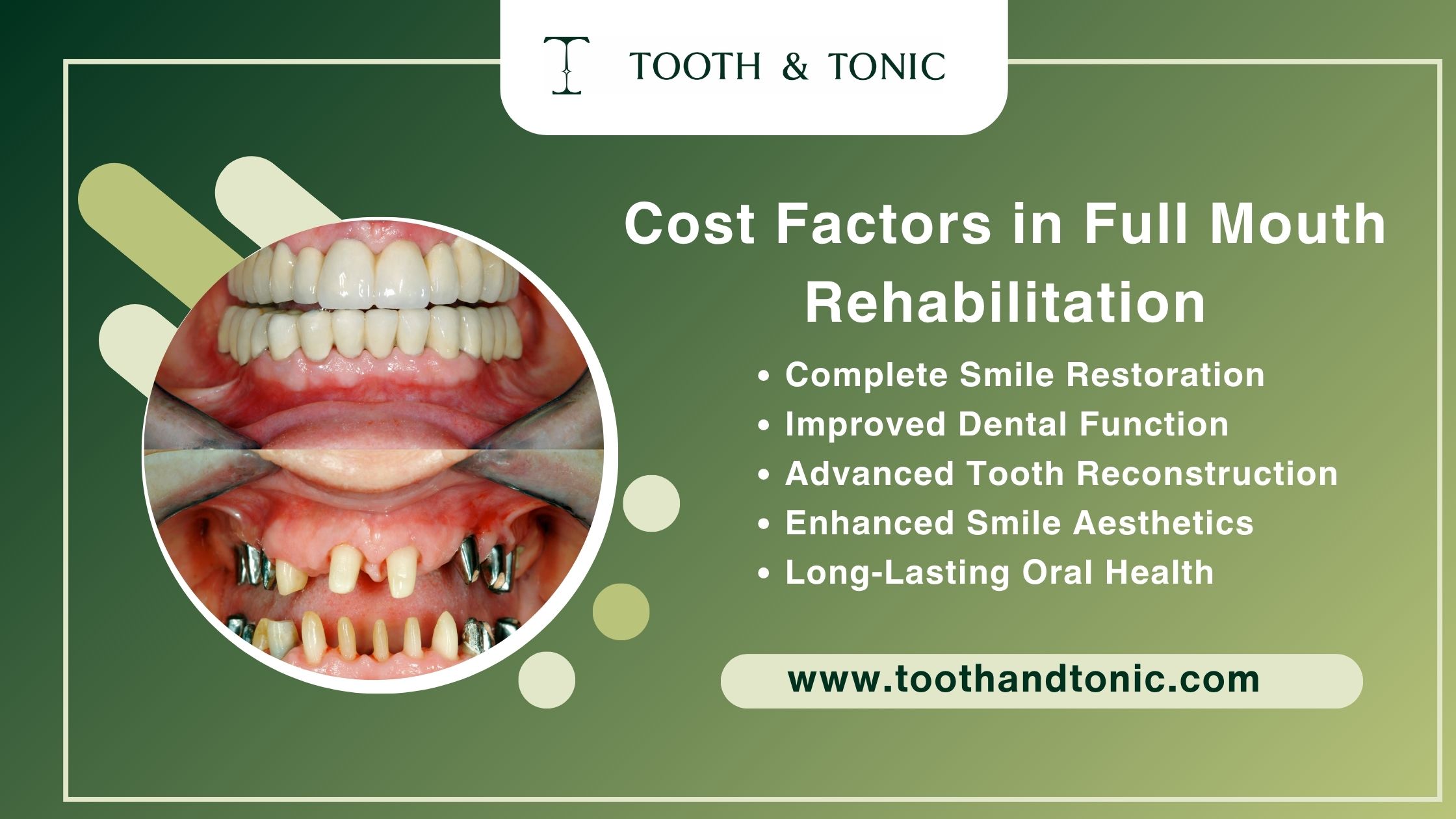 Dentist discussing full mouth rehabilitation treatment plan with patient.