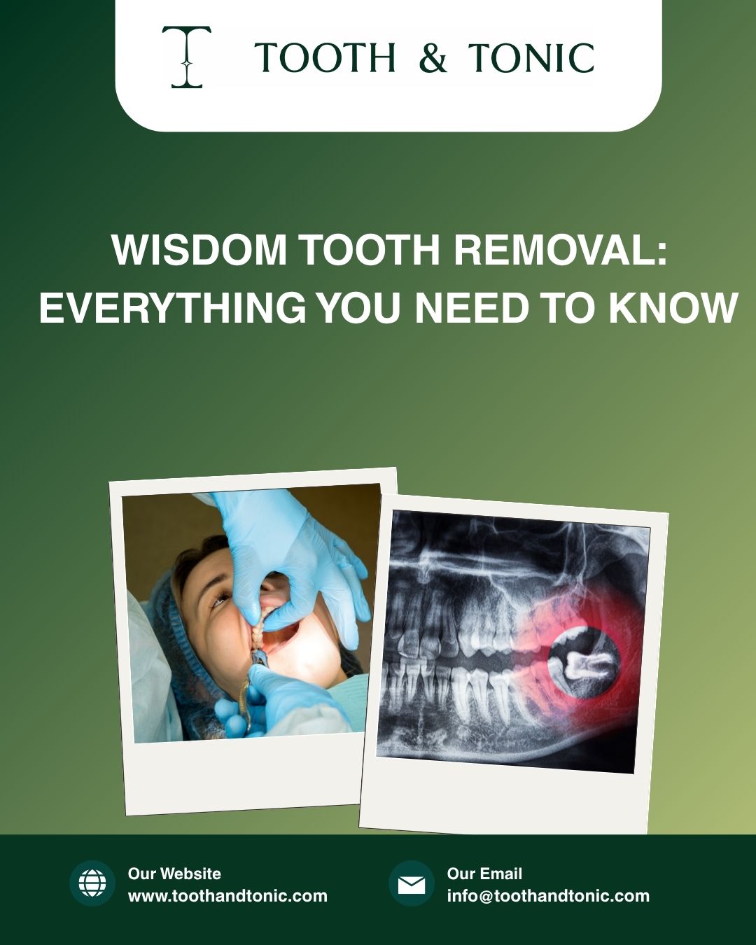 Wisdom Tooth Removal