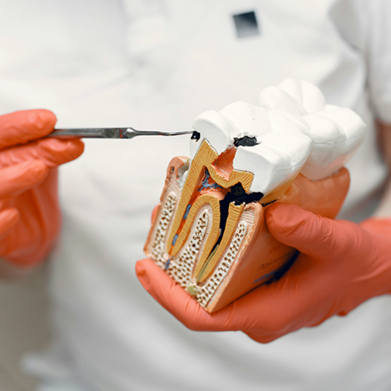 Root Canal