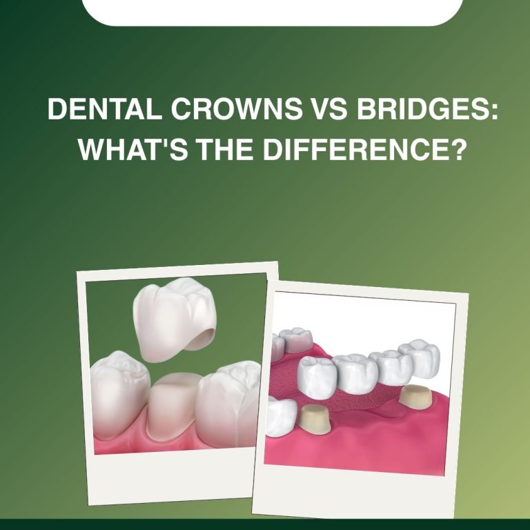 Dental Crowns vs Bridges What's the Difference