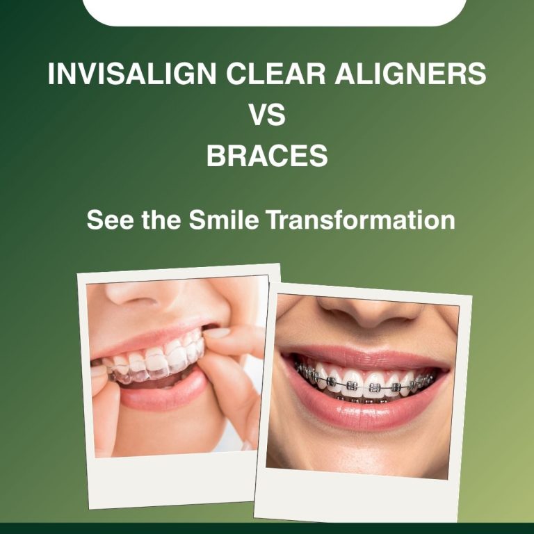 Invisalign Clear Aligners vs Braces: Which Orthodontic Treatment is Best for Your Smile?