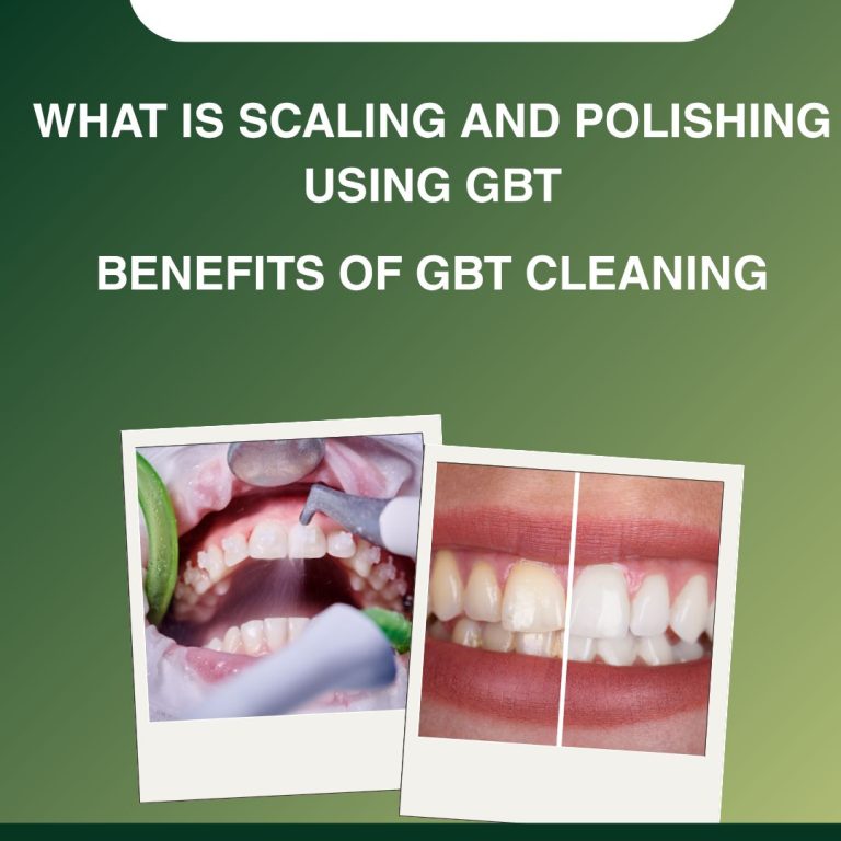 What Is Scaling and Polishing Using GBT? Benefits of GBT Cleaning